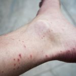 Аллергия на укусы блох