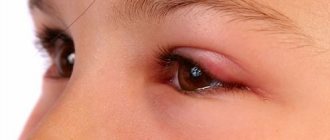 укус мошки в глаз лечение